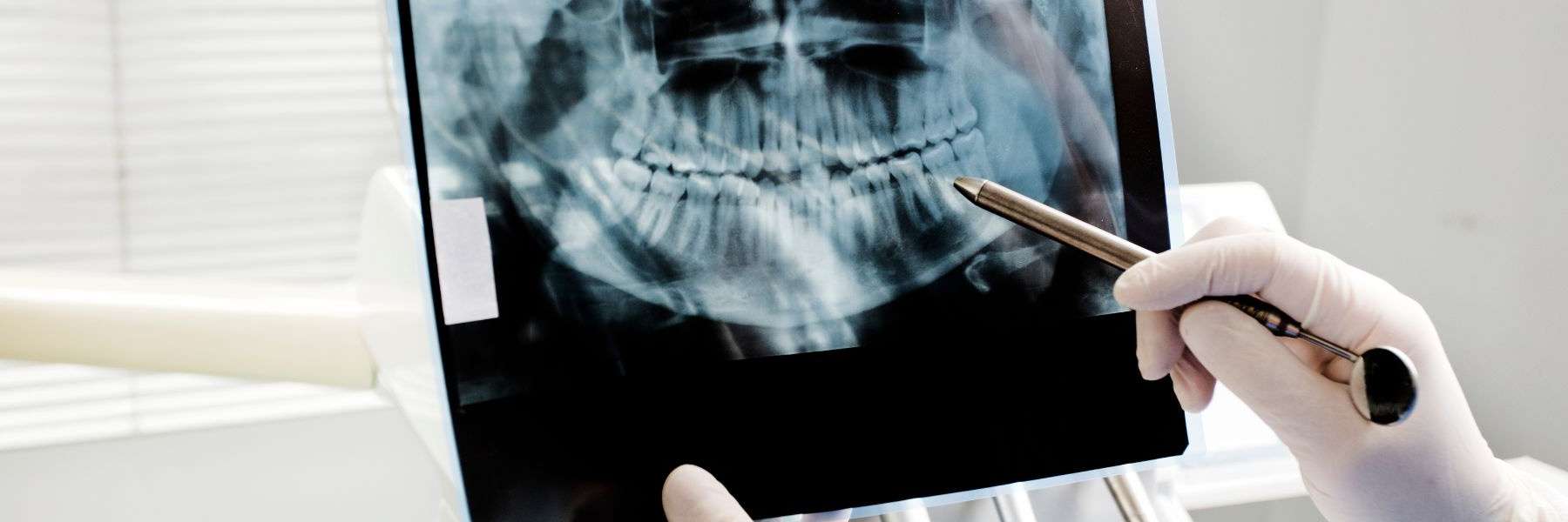 Full Mouth Reconstruction | Dentist